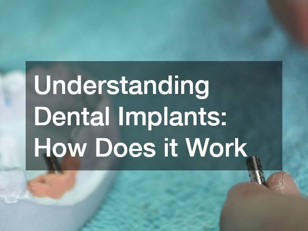 Understanding Dental Implants How Does it Work